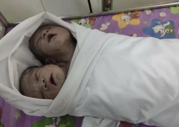 Cặp song sinh chung một cơ thể và hai đầu được sinh ra ở Myanmar - Sputnik Việt Nam