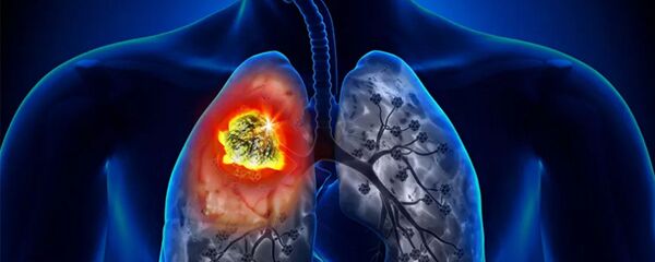 Ung thư phổi - Sputnik Việt Nam