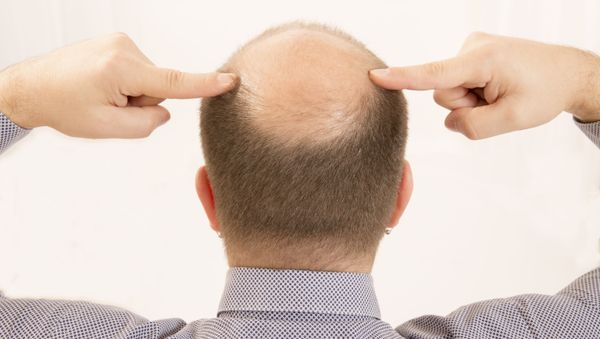 Các nhà khoa học đã tìm ra một loại thuốc chống rụng tóc - Sputnik Việt Nam