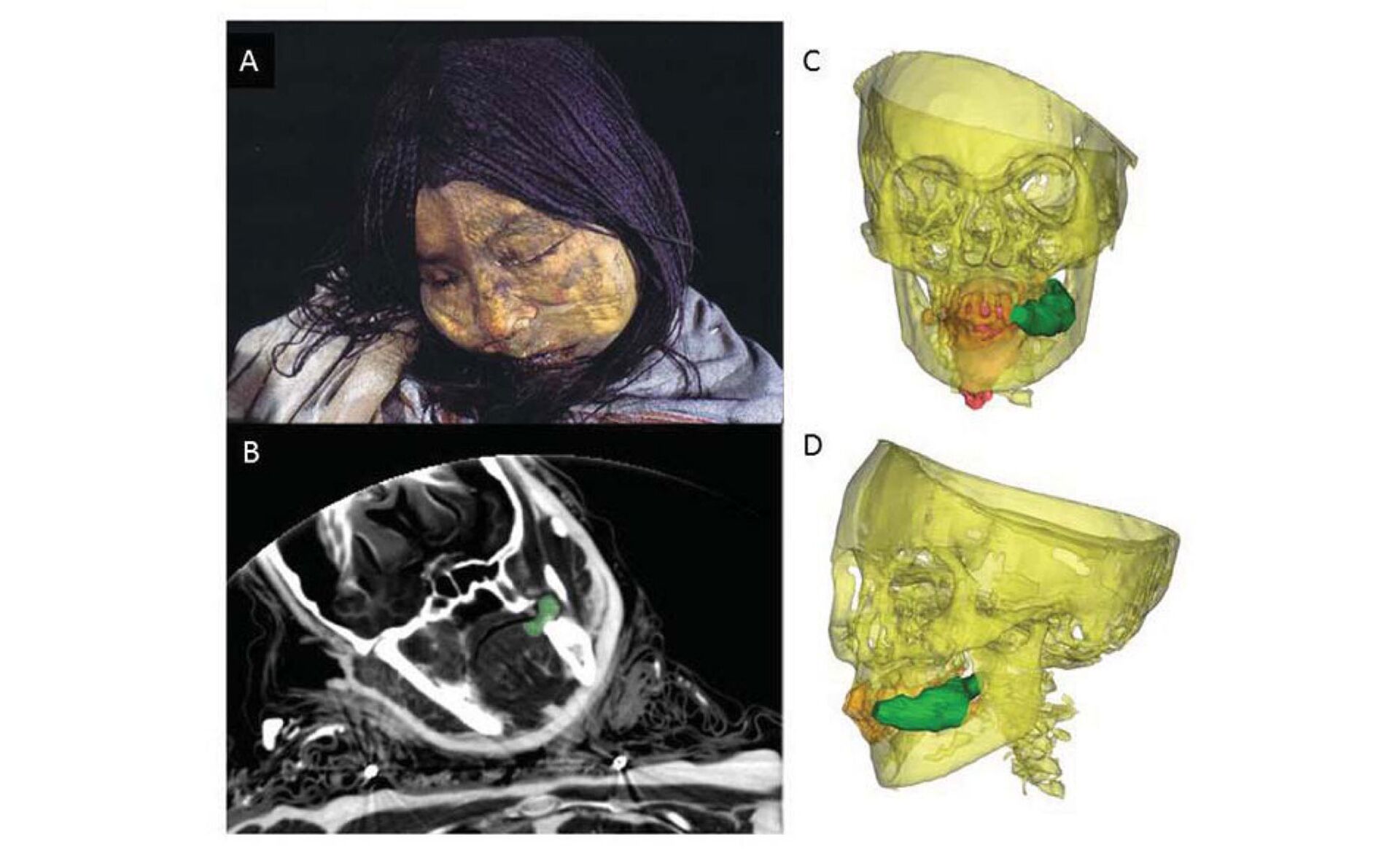 Xác ướp của Công chúa băng giá được tìm thấy trên sườn núi lửa Llullaillaco. Vết xanh là kẹo cao su lá Coca - Sputnik Việt Nam, 1920, 11.08.2025