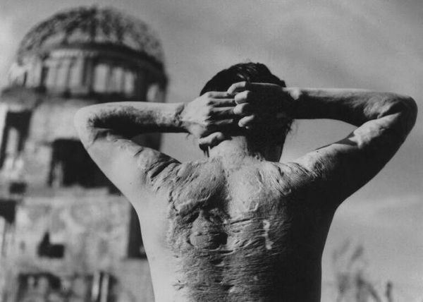 Một nạn nhân của quả bom nguyên tử thả xuống Hiroshima vào ngày 6 tháng 8 năm 1945 - Sputnik Việt Nam