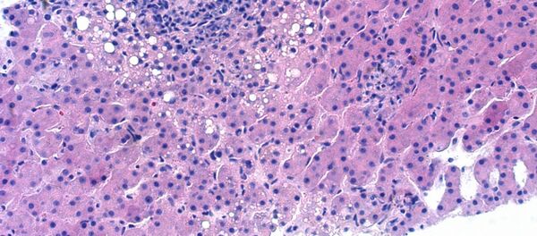 Virus gây bệnh viêm gan siêu vi - Sputnik Việt Nam