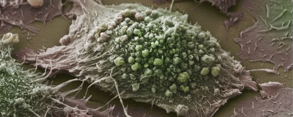 ung thư ung thư - Sputnik Việt Nam