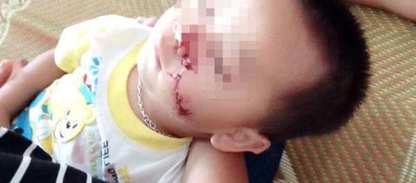 Vết thương lớn ở mặt cháu bé. - Sputnik Việt Nam