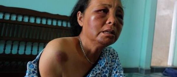 Bà Phúc (một trong 2 người phụ nữ bị đánh) mặt mũi vẫn sưng tím, đau nhức vì bị nhiều người dân hành hung Bà Phúc (một trong 2 người phụ nữ bị đánh) mặt mũi vẫn sưng tím, đau nhức vì bị nhiều người dân hành hung - Sputnik Việt Nam