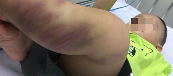 Những vết bầm tím trên cơ thể cháu bé. - Sputnik Việt Nam