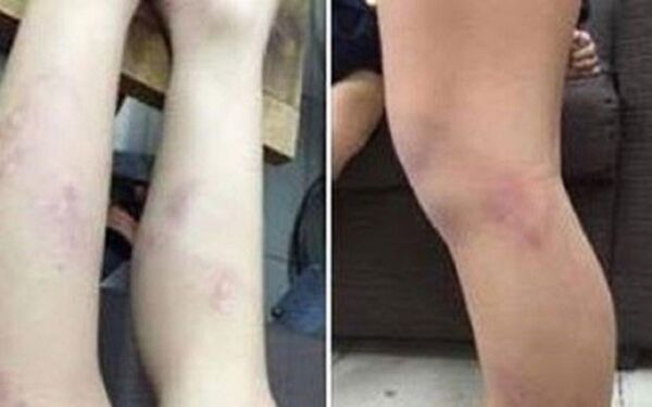 Phụ huynh bức xúc chia sẻ hình ảnh hai chân của con bị bầm tím do cô giáo dùng thước kẻ đánh. - Sputnik Việt Nam