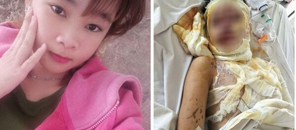 Nạn nhân Trần Ngọc Đẹp trước và sau khi bị kẻ xấu tạt axit. - Sputnik Việt Nam