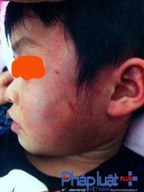 Những vết thâm tím xuất hiện dày đặc trên mặt cháu L.T.D - Sputnik Việt Nam