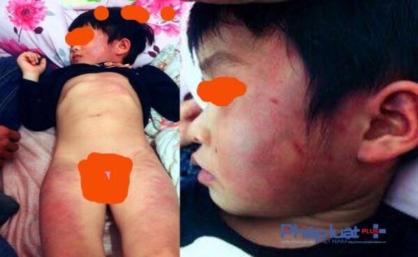 Với những vết thương toàn thân như vậy, gia đình cháu L.T.D nghi ngờ cháu bị cô giao đánh - Sputnik Việt Nam