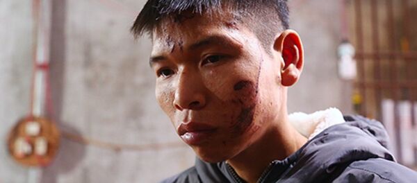 Anh Đặng Đình Tiến vẫn chưa lành vết thương sau vụ nổ sáng 3/1. - Sputnik Việt Nam