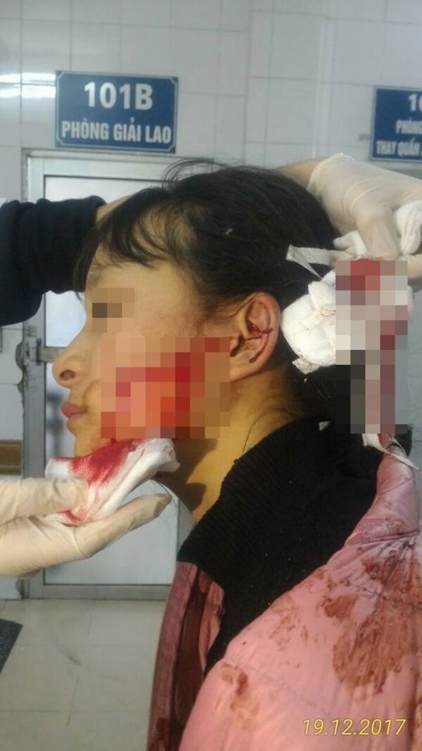 Hiện trường gương mặt bị rạch lênh láng máu của em P.L. tại bệnh viện Hiện trường gương mặt bị rạch lênh láng máu của em P.L. tại bệnh viện - Sputnik Việt Nam