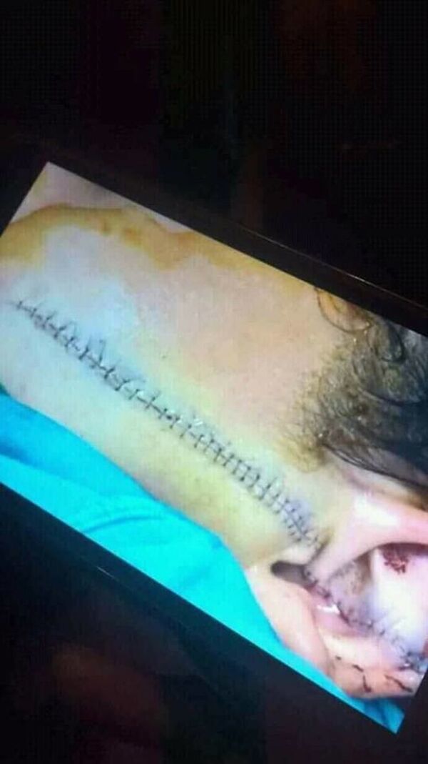 Tình trạng sau khi tiến hành khâu của P.L. Tuy nhiên gia đình đã phải đưa em về điều trị tại nhà vì hoàn cảnh khó khăn. Tình trạng sau khi tiến hành khâu của P.L. Tuy nhiên gia đình đã phải đưa em về điều trị tại nhà vì hoàn cảnh khó khăn. - Sputnik Việt Nam