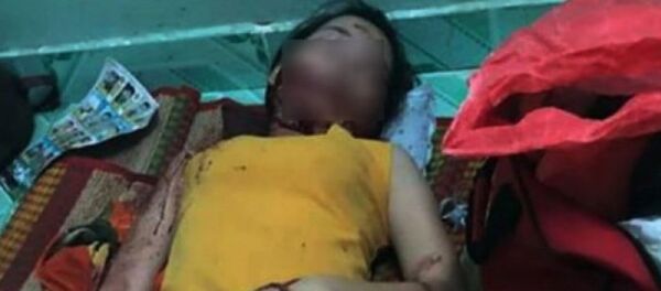 Nạn nhân bị chém với vết thương trên mặt - Sputnik Việt Nam