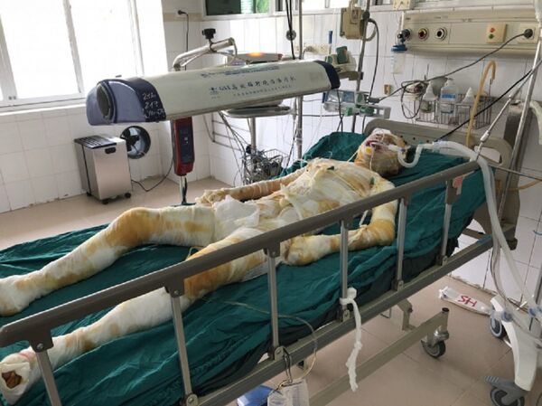 H. đang nằm điều trị tại viện Bỏng Quốc gia, bị bỏng 92% - Sputnik Việt Nam