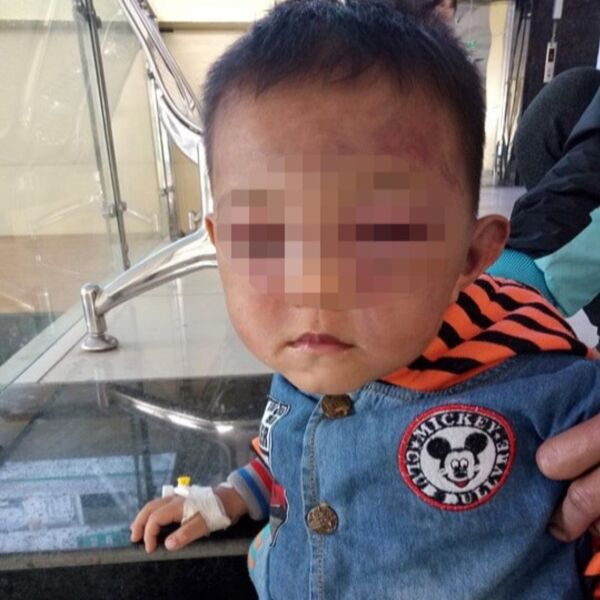 Cháu H. bị đánh sưng tím cả vùng mặt - Sputnik Việt Nam