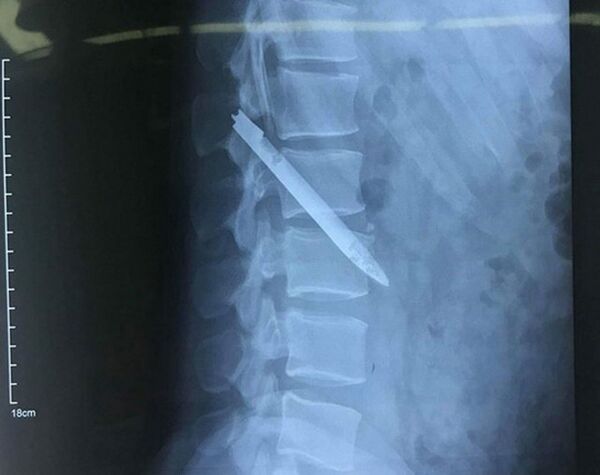 Lưỡi dao nằm trong người chiến sĩ Nam suốt 11 năm.  - Sputnik Việt Nam