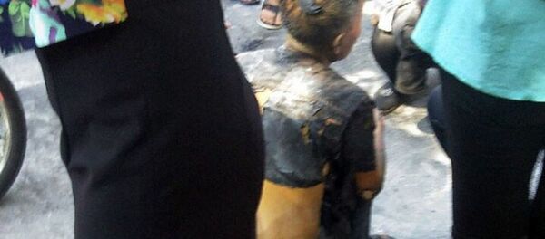 Cụ ông bỏng nặng - Sputnik Việt Nam