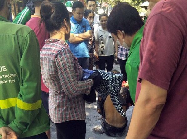 Nạn nhân bỏng nặng, được đưa vào viện cấp cứu.  - Sputnik Việt Nam