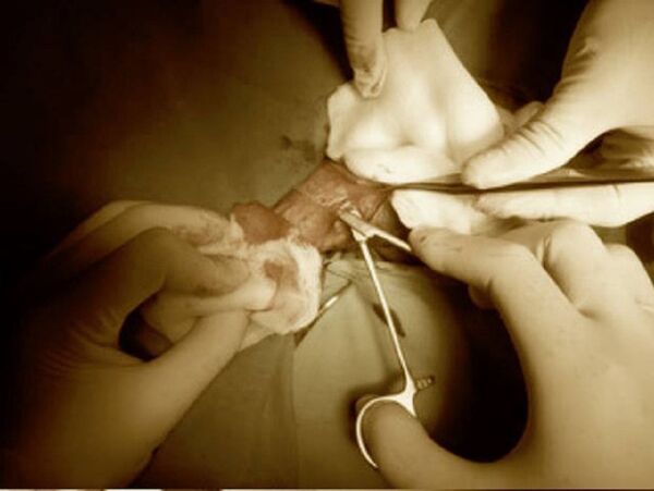 Ca phẫu thuật cho bệnh nhân biến chứng sau tiêm silicon - Sputnik Việt Nam