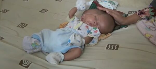 Một đứa trẻ hai khuôn mặt được sinh ra ở Indonesia - Sputnik Việt Nam