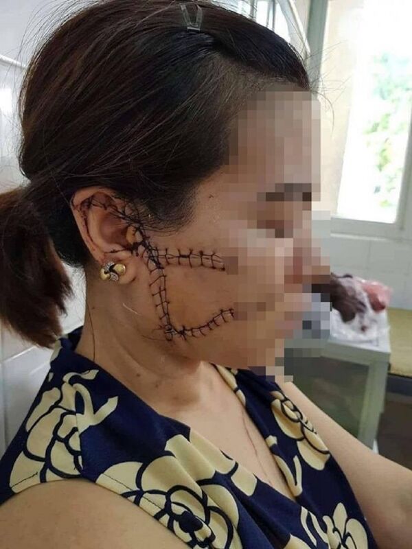 Khuôn mặt đầy vết sẹo của chị O. - Sputnik Việt Nam