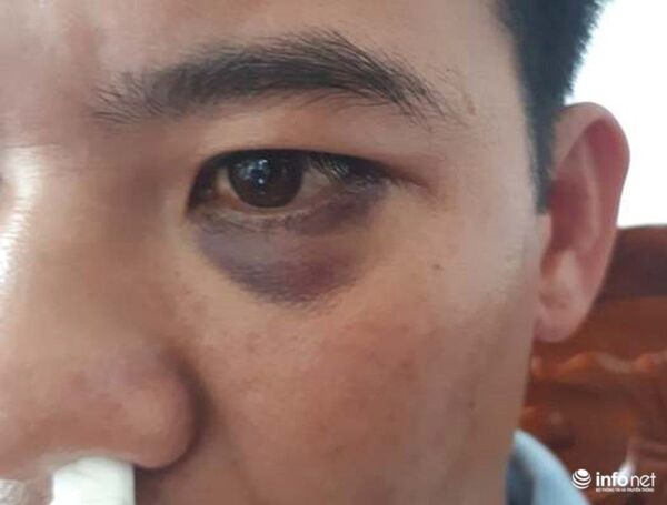 Vết bầm tím trên mắt của thầy giáo Bảo. - Sputnik Việt Nam