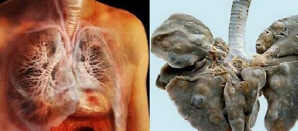 Lá phổi bị nhiễm sán Lá phổi bị nhiễm sán - Sputnik Việt Nam