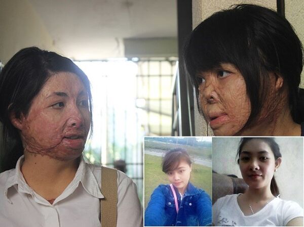 2 cô gái bị chồng đốt tựa vào nhau tìm lại hình hài - Sputnik Việt Nam