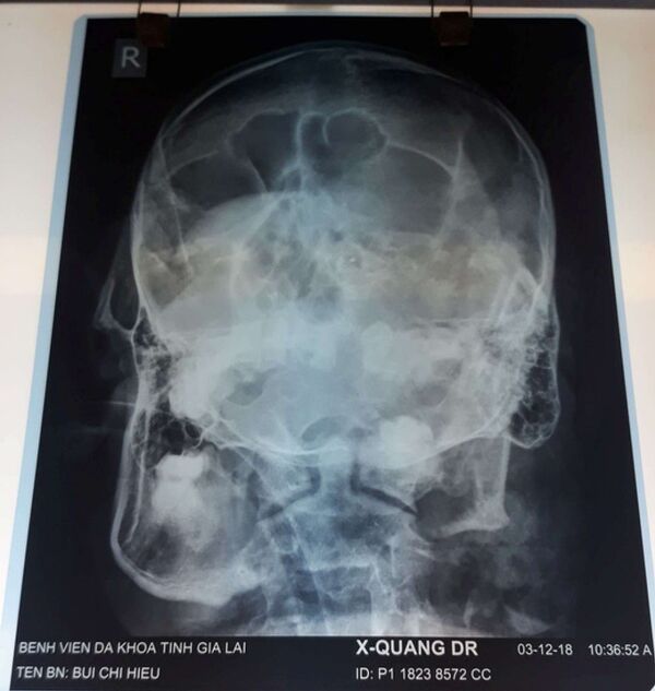 Sau khi khống chế bắn chết phó chủ tịch HĐND, nghi phạm đã dùng súng bắn vào phần đầu để tự sát Sau khi khống chế bắn chết phó chủ tịch HĐND, nghi phạm đã dùng súng bắn vào phần đầu để tự sát - Sputnik Việt Nam