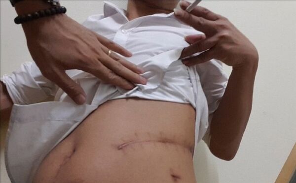 Vết mổ bán thận của Hoàng - Sputnik Việt Nam