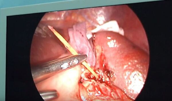 Cây tăm được lấy ra khỏi lá lách - Sputnik Việt Nam