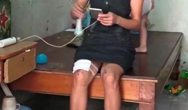Chị B. và con trai bị thương sau vụ nổ chiếc micro hát karaoke. 