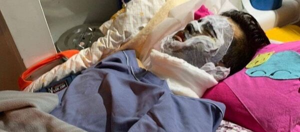 Nạn nhân bị bỏng nặng vùng mặt, cặp mắt bị tổn thương nghiêm trọng Nạn nhân bị bỏng nặng vùng mặt, cặp mắt bị tổn thương nghiêm trọng - Sputnik Việt Nam