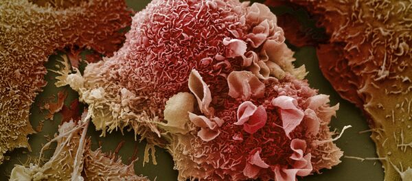 ung thư - Sputnik Việt Nam