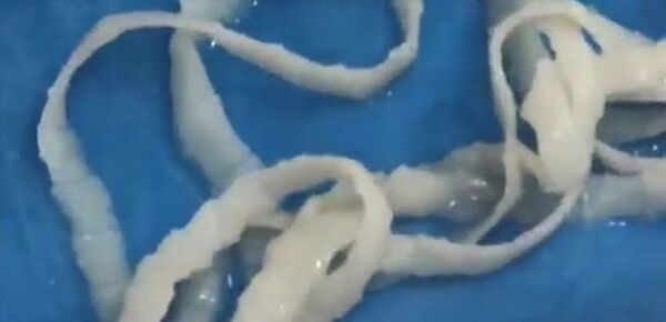 Sán dài 5,2 m từ cô gái 27 tuổi - Sputnik Việt Nam