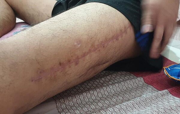 Đùi trái của Nguyễn Trọng Cường (32 tuổi) bị khâu nhiều mũi sau khi cảnh sát 113 nổ súng. - Sputnik Việt Nam