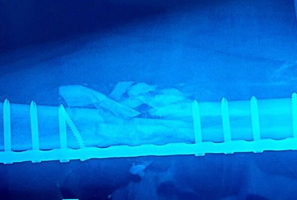 Phần xương đùi của Cường bị vỡ sau khi được chụp chiếu lại.  - Sputnik Việt Nam