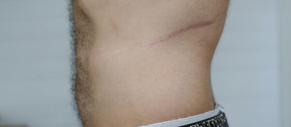 Ảnh một người được cấy ghép nội tạng Ảnh một người được cấy ghép nội tạng - Sputnik Việt Nam