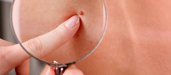 nốt ruồi - Sputnik Việt Nam