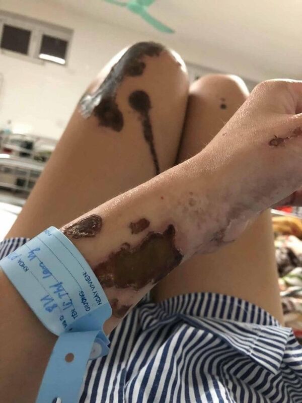 Vụ tạt axit vợ chưa cưới: Xử mức án cao nhất của khung hình phạt - Sputnik Việt Nam