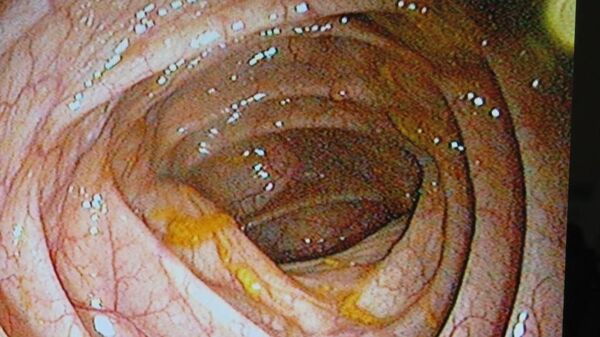 Cấy phân: phương pháp điều trị mới nhất hay chỉ là một cơn điên cuồng? Cấy phân: phương pháp điều trị mới nhất hay chỉ là một cơn điên cuồng? - Sputnik Việt Nam