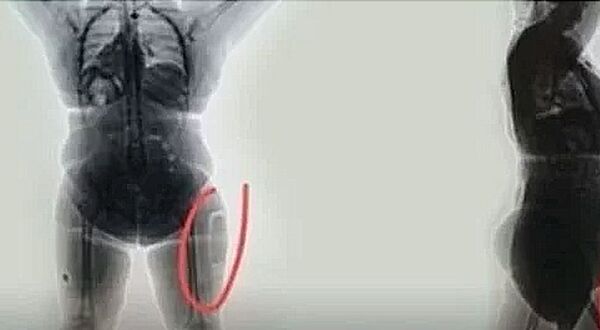 Nữ hành khách đi máy bay khâu bắp chân để giấu gần 1kg cocaine và bị bắt - Sputnik Việt Nam