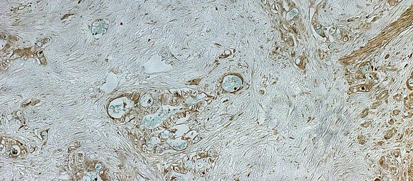 Mô học ung thư tuyến tụy - Sputnik Việt Nam