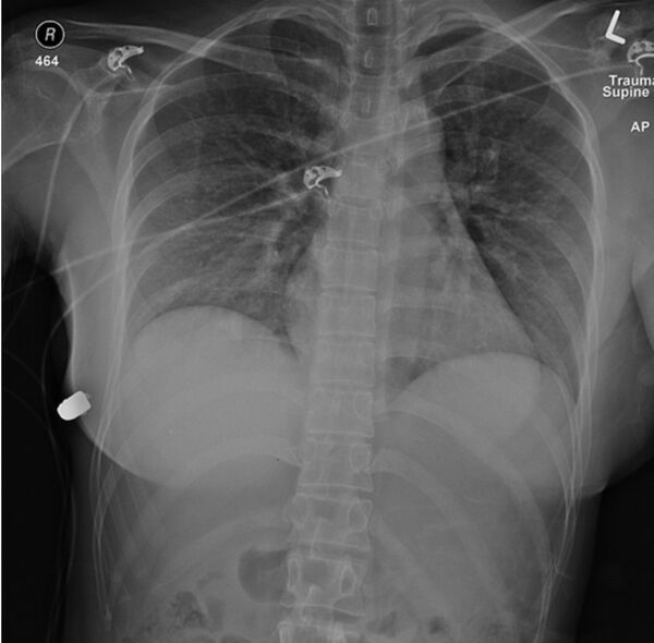 Cô gái sống sót sau phát đạn bắn thăng vào tim nhờ ngực silicon Cô gái sống sót sau phát đạn bắn thăng vào tim nhờ ngực silicon - Sputnik Việt Nam