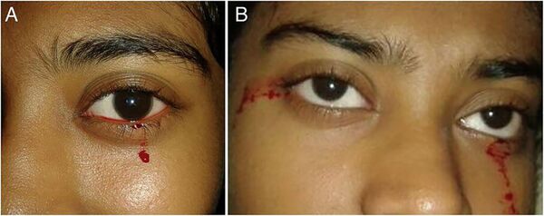 Hội chứng khiến con người khóc ra máu Hội chứng khiến con người khóc ra máu - Sputnik Việt Nam