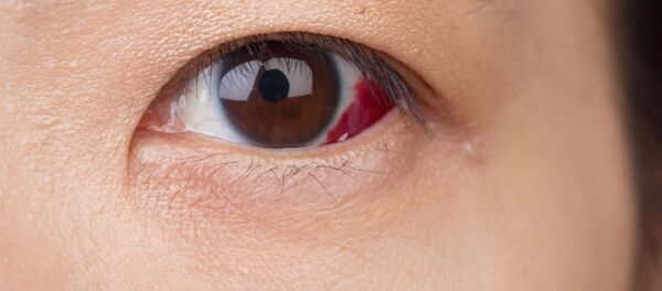 Mắt có máu Mắt có máu - Sputnik Việt Nam